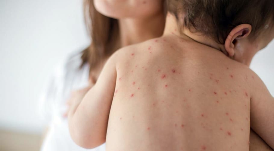خسرے کی وبا میں اس سال 3 گنا اضافہ ریکارڈ کیا گیا۔عالمی ادارہ صحت