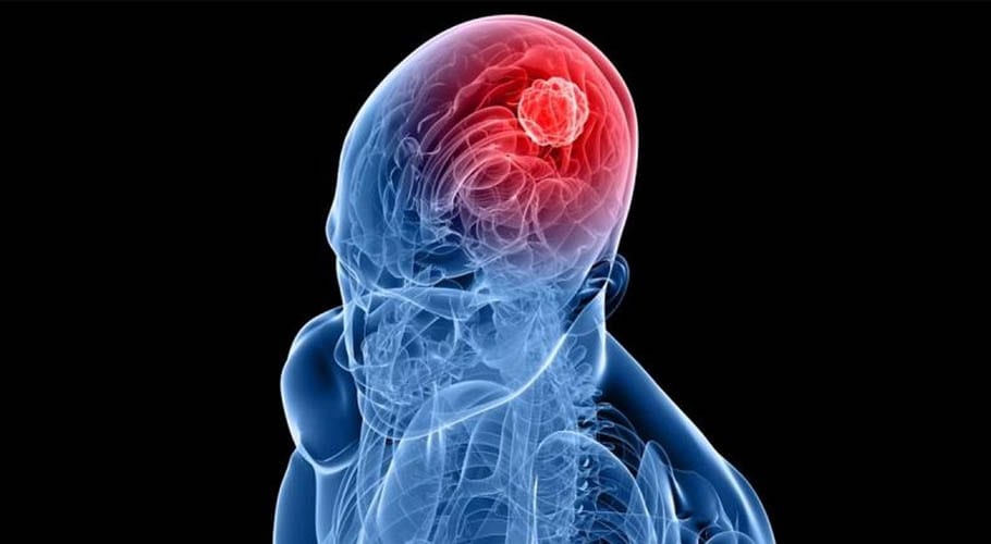 پاکستان سمیت دنیا بھر میں کینسر سے بچاؤ کا عالمی دن آج منایا جارہا ہے