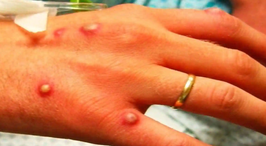 دنیا میں پھیلتی ایک اور وبا منکی پاکس کتنی خطرناک ہے؟