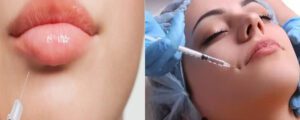 بیوٹی انجیکشن لگانے والوں کے خلاف کریک ڈاؤن کا آغاز