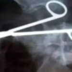 Scissors left in abdomen after surgery kill Faisalabad woman