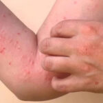 Chikungunya Causes, Symptoms, Diagnosis & Treatment