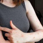 Suspected Monkeypox case reported in Karachi