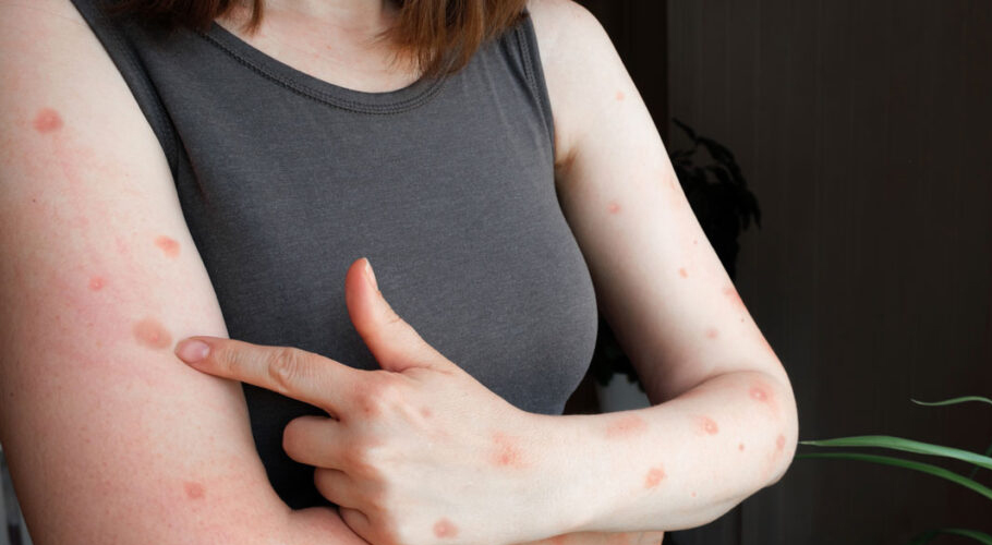Suspected Monkeypox case reported in Karachi