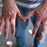 mpox