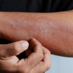 Karachi reports spike in skin disease cases following monsoon rains