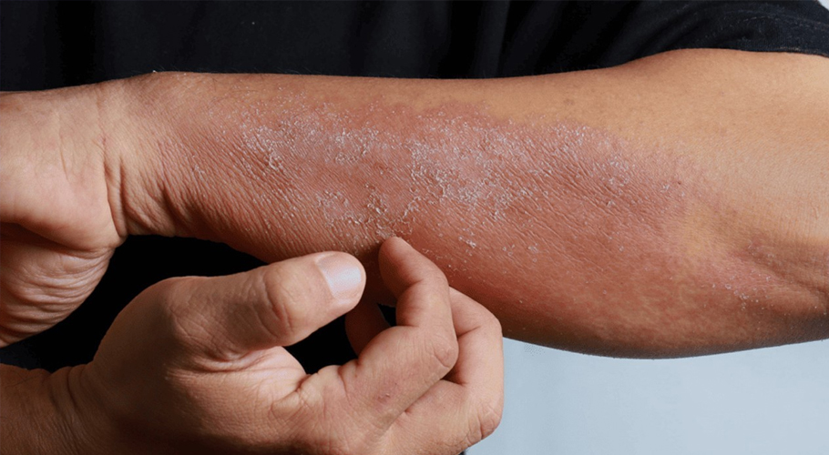 Karachi reports spike in skin disease cases following monsoon rains